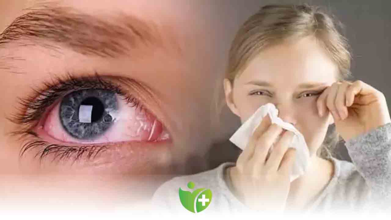 Tokalaşmayla bile bulaşabiliyor! Göz nezlesi salgınına Dikkat! 7