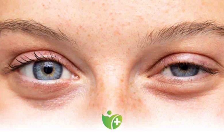 Çocuklar da Göz kapak sarkması! 1