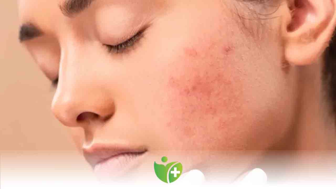 Kış güneşi de güneş alerjisini tetikliyor! 7