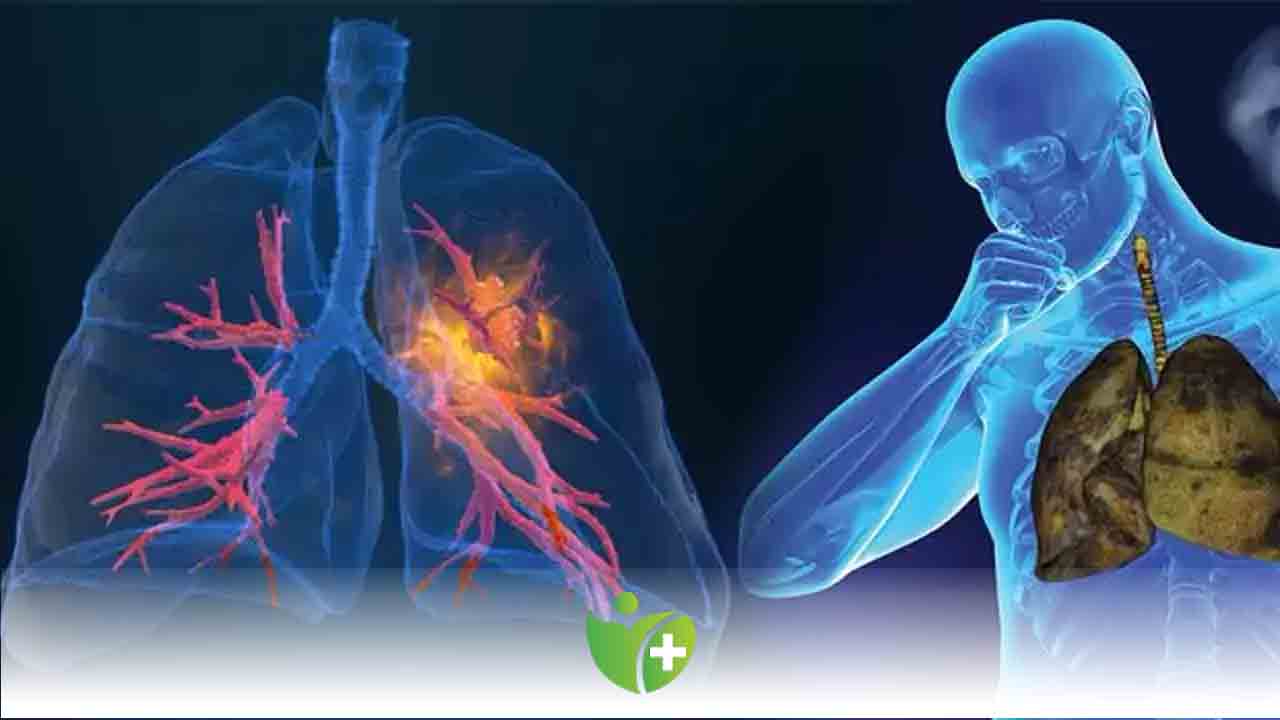 Akciğer kanserini en çok etkileyen sigara 7