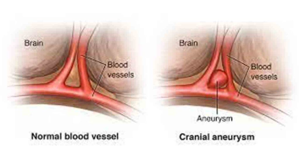 Beyin Anevrizması ve Anjiografik Tedavisi 2