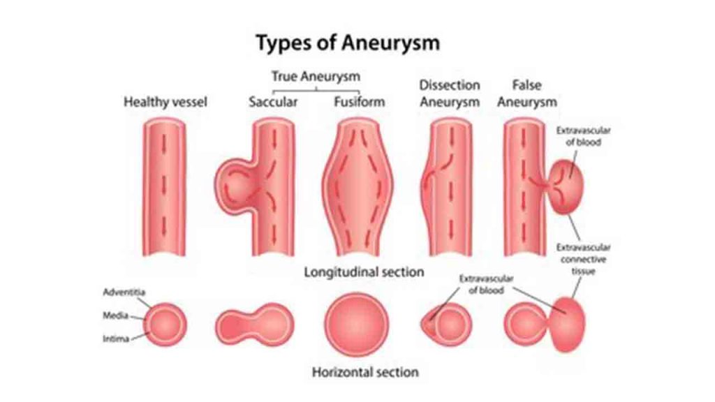 Beyin Anevrizması ve Anjiografik Tedavisi 3