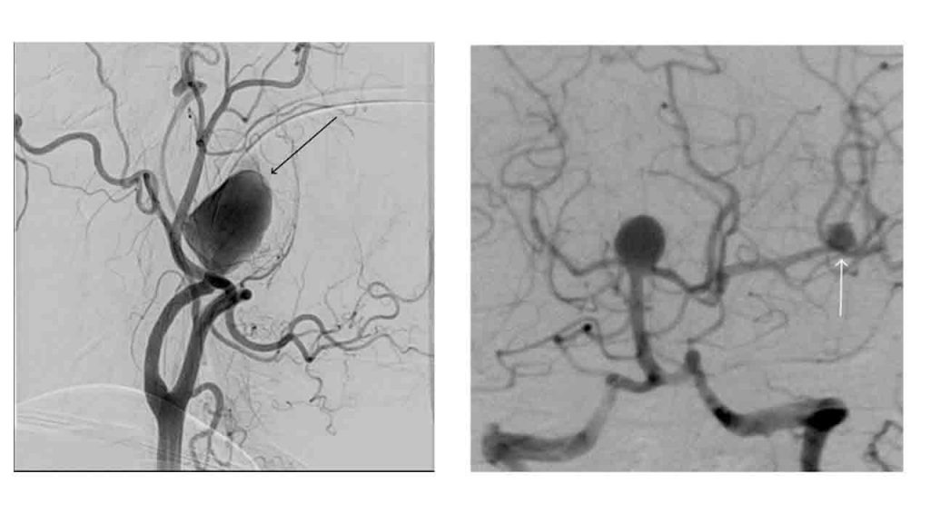 Beyin Anevrizması ve Anjiografik Tedavisi 5