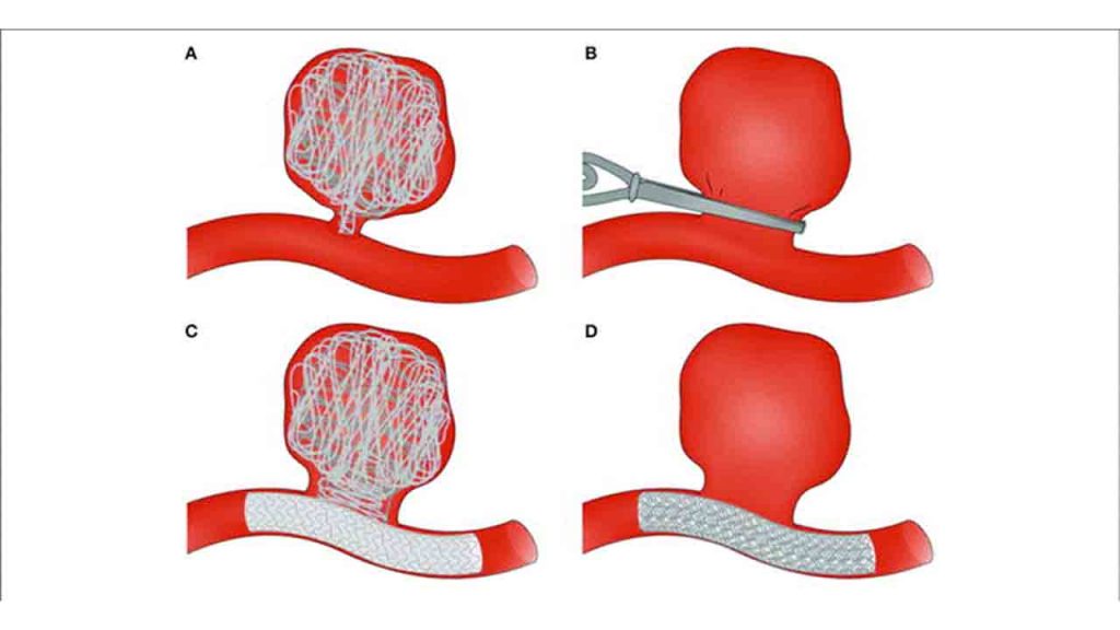Beyin Anevrizması ve Anjiografik Tedavisi 6
