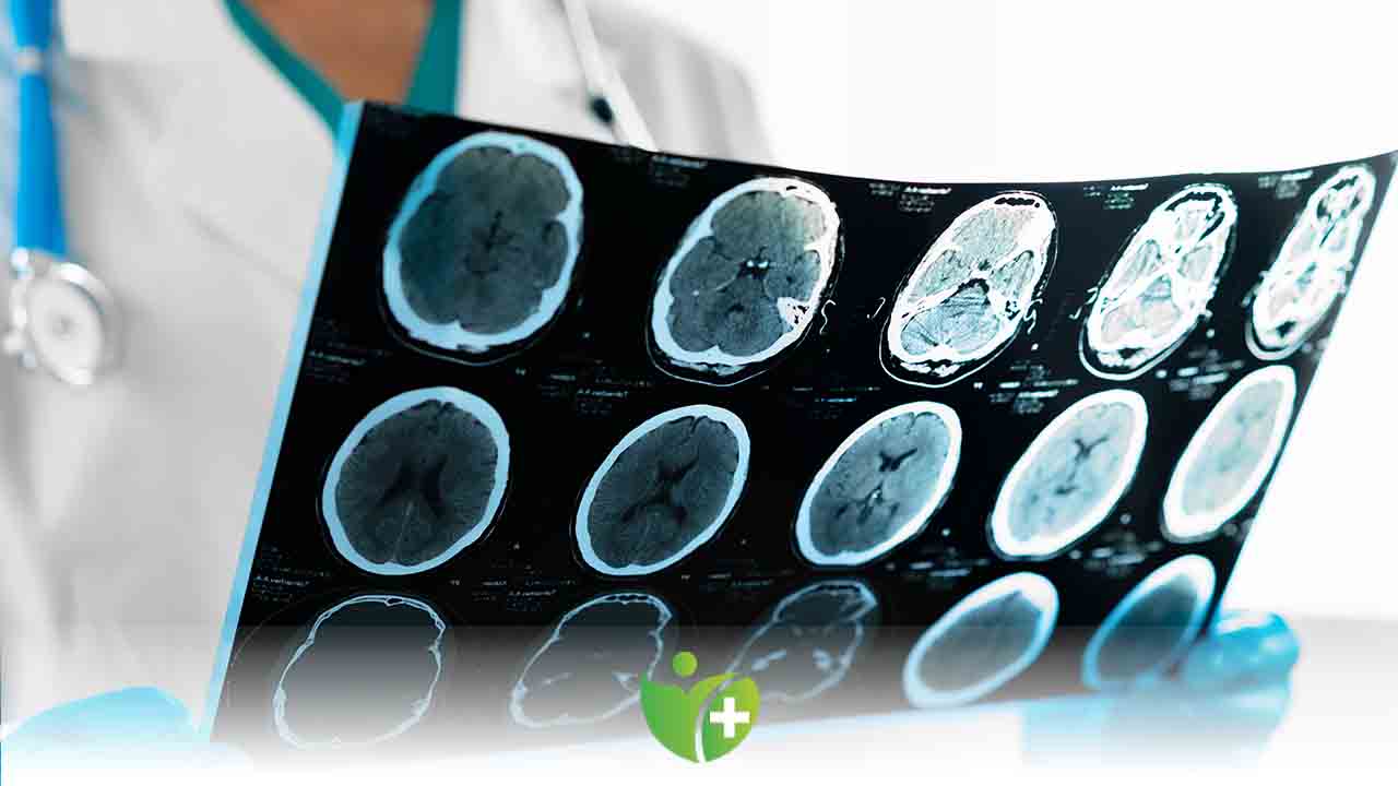 Beyin Kanaması önlenebilir mi? 7