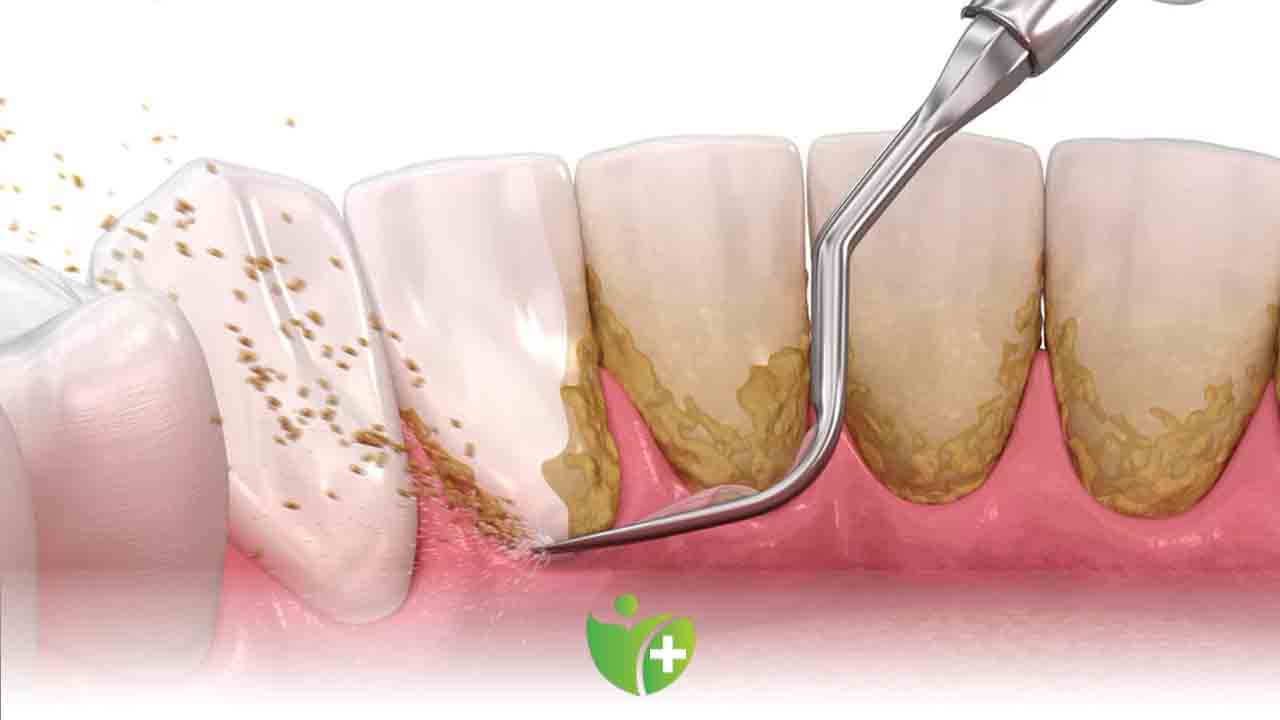Diş taşının temizlenmemesi diş kaybına yol açabiliyor 7