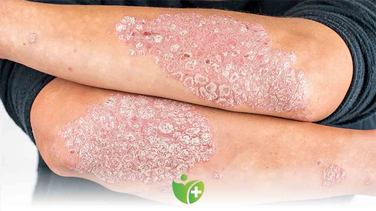 Egzama mevsim geçişlerinde daha sık görülüyor 7