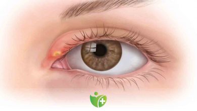 Göz de Arpacık neden çıkar? Nasıl tedavi edilir? 19