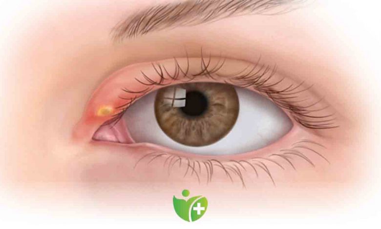 Göz de Arpacık neden çıkar? Nasıl tedavi edilir? 1