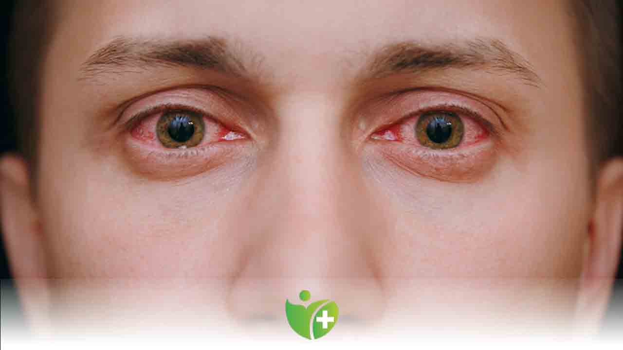 Kalıcı hasar bırakıyor: Kırmızı göz salgını! 7