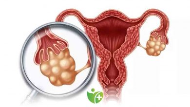 Pkos Sendromunuz varsa bu 8 belirtiye dikkat! 7