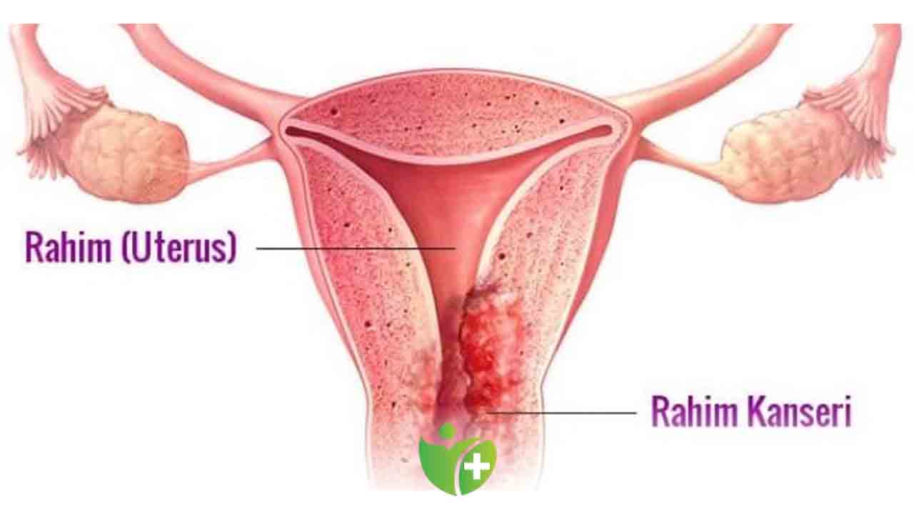 Rahim ağzı kanserinden korunmanın yolu aşı ve tarama 7