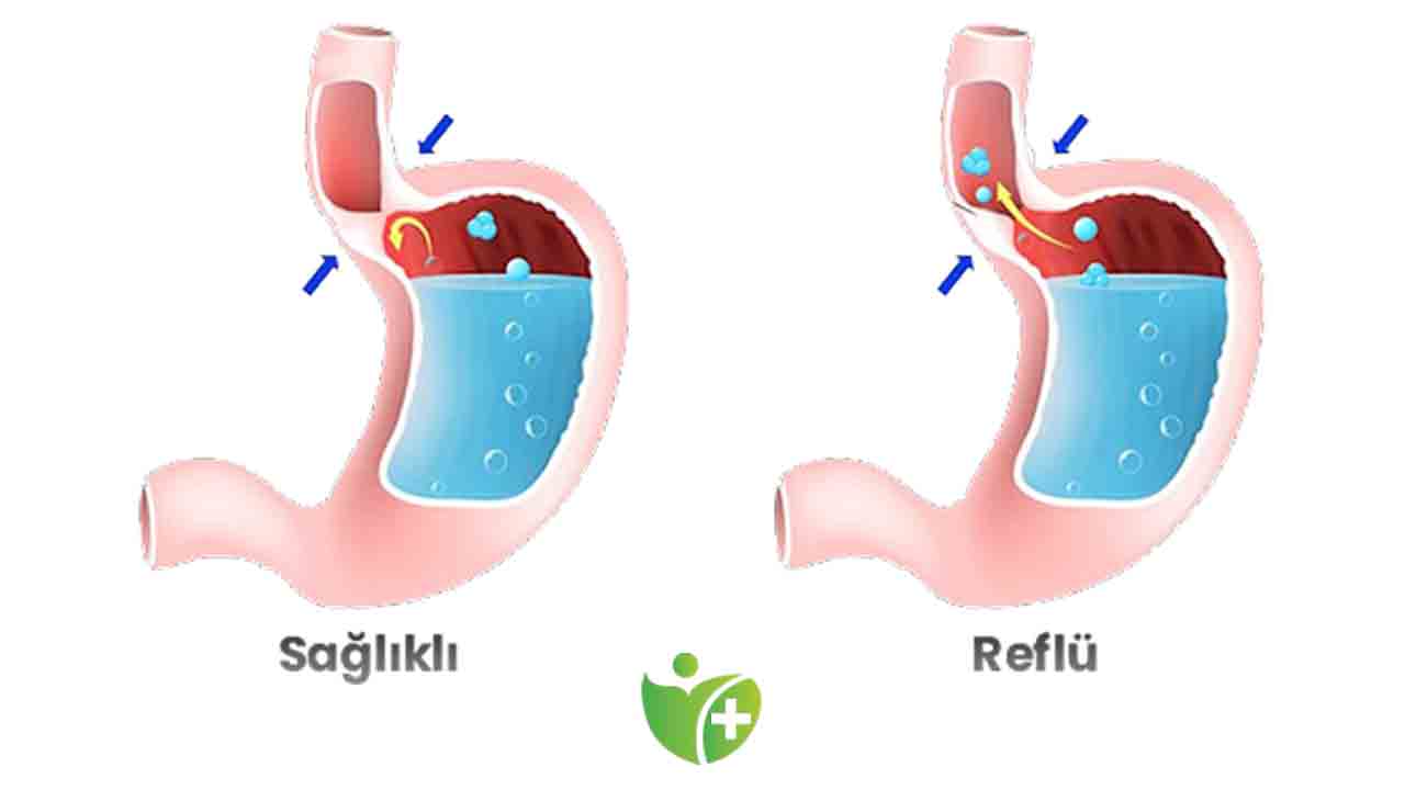Reflünün tedavisi için sağlıklı yaşam şart 7