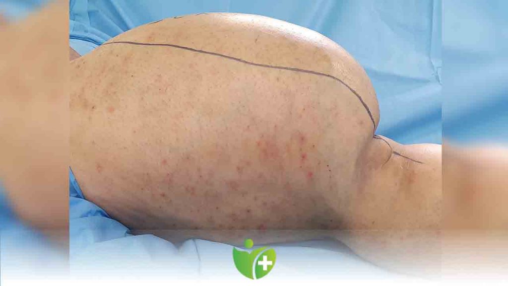 SEAH’ta yapılan ameliyatla bacağı kesilmekten kurtuldu 2