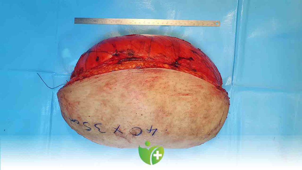 SEAH’ta yapılan ameliyatla bacağı kesilmekten kurtuldu 3