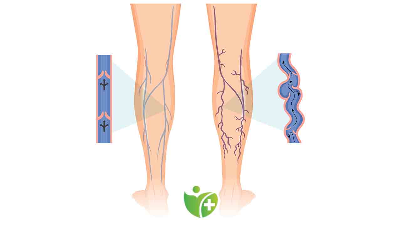 Varisin 5 Önemli belirtisi 7