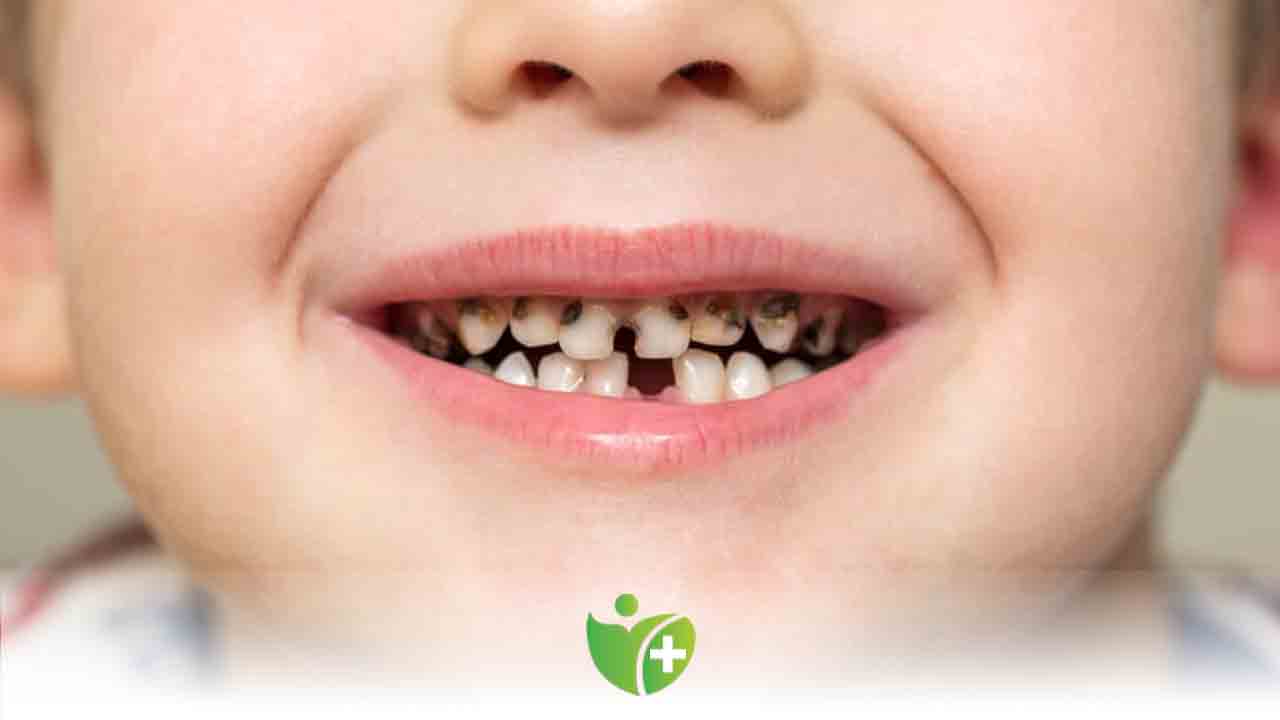 Çocuklar da Diş çürüğü neden olur? Nelere dikkat edilmeli? 7