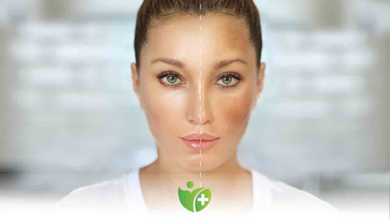 Dermatoloji uzmanı : “Leke tedavisi, yaz gelmeden yapılmalı” 7