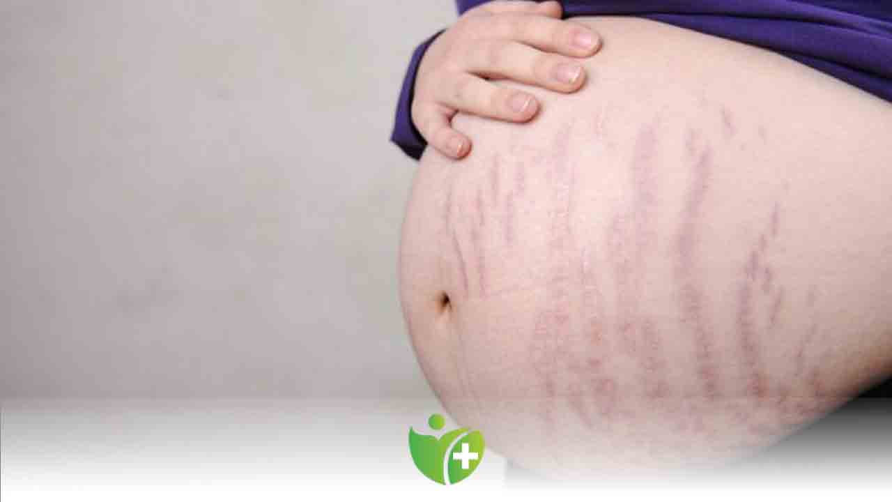 Hamilelik Çatlaklarına Dikkat! 7