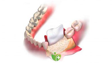 İmplant yapılabilmesi için kemik erimesine karşı yenilikçi çözümler var! 2