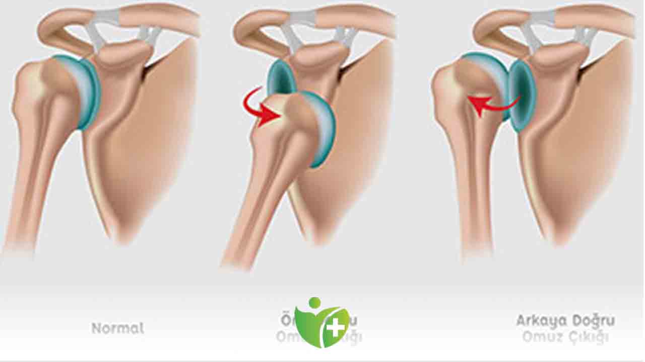 Tedavi edilmeyen Omuz çıkığı tekrarlayabiliyor 6