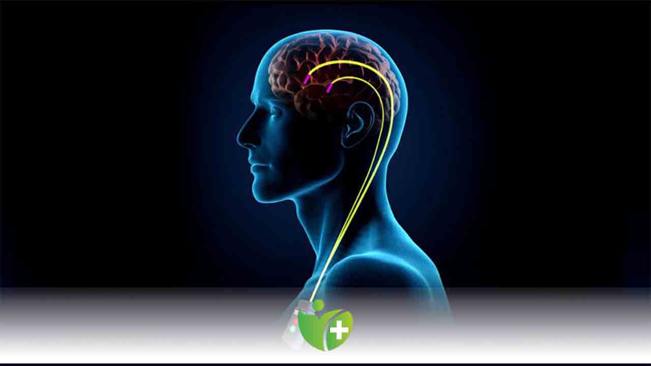 Titreme sorununa karşı beyin pili tedavisi 7