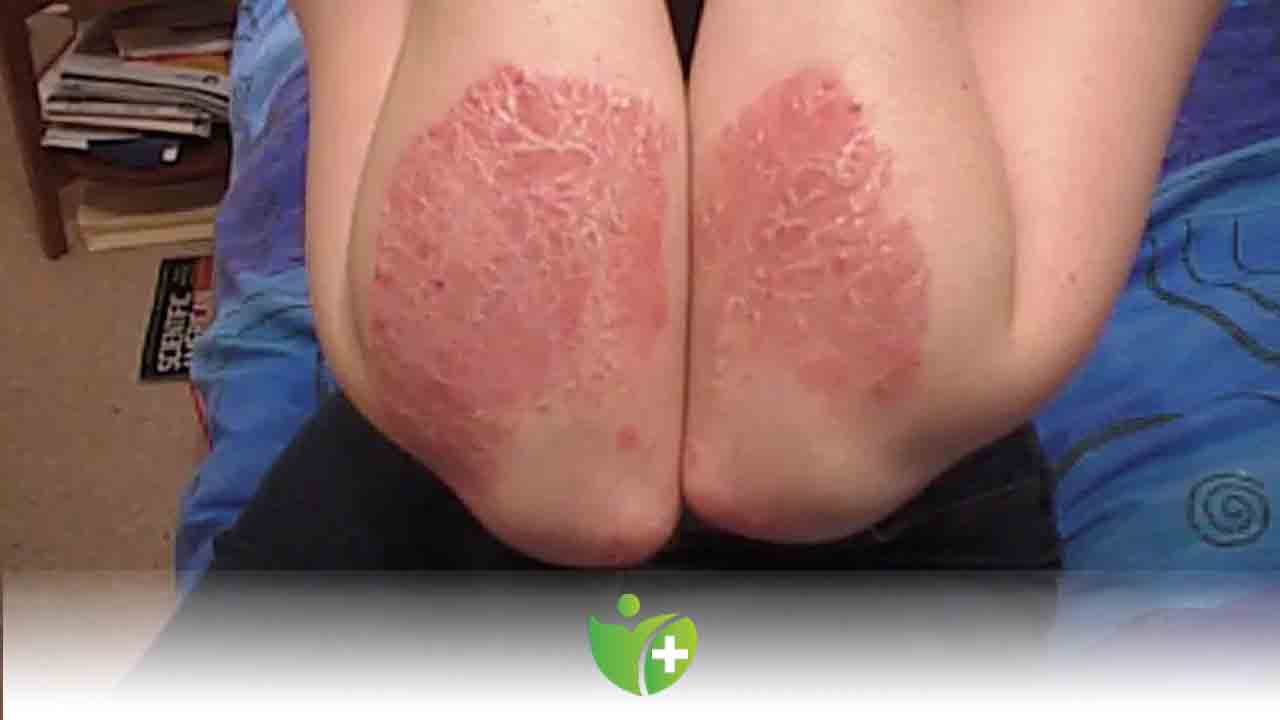 Sedef Hastalığında Beslenmenin Önemi! 7