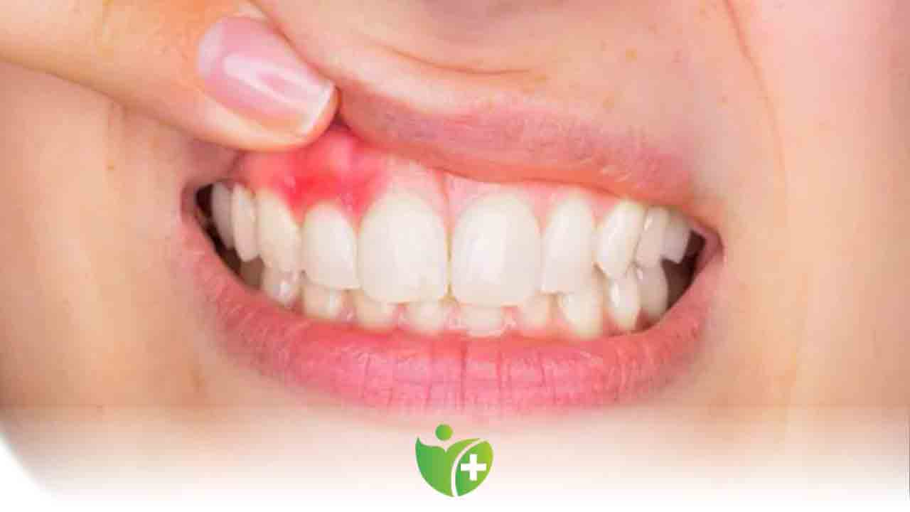 Diş temizliğindeki eksikler diş eti büyümesine neden oluyor! 7