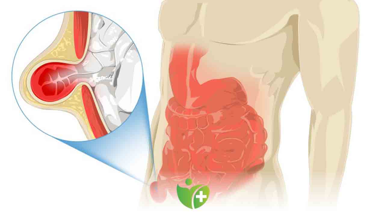 Sigara içenlerde kasık fıtığı daha çok görülüyor! 7