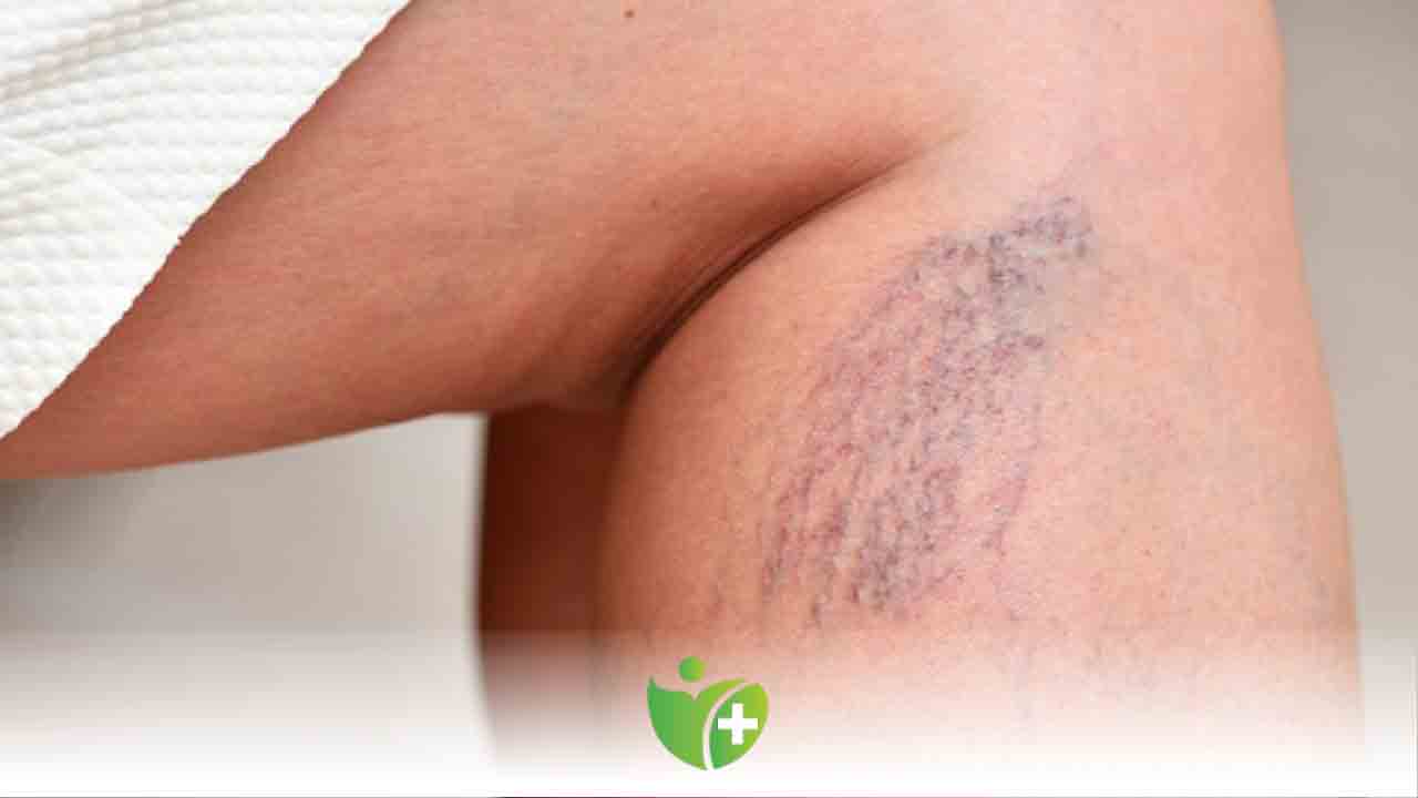 Yazın varislerden nasıl korunmak gerekir? 7