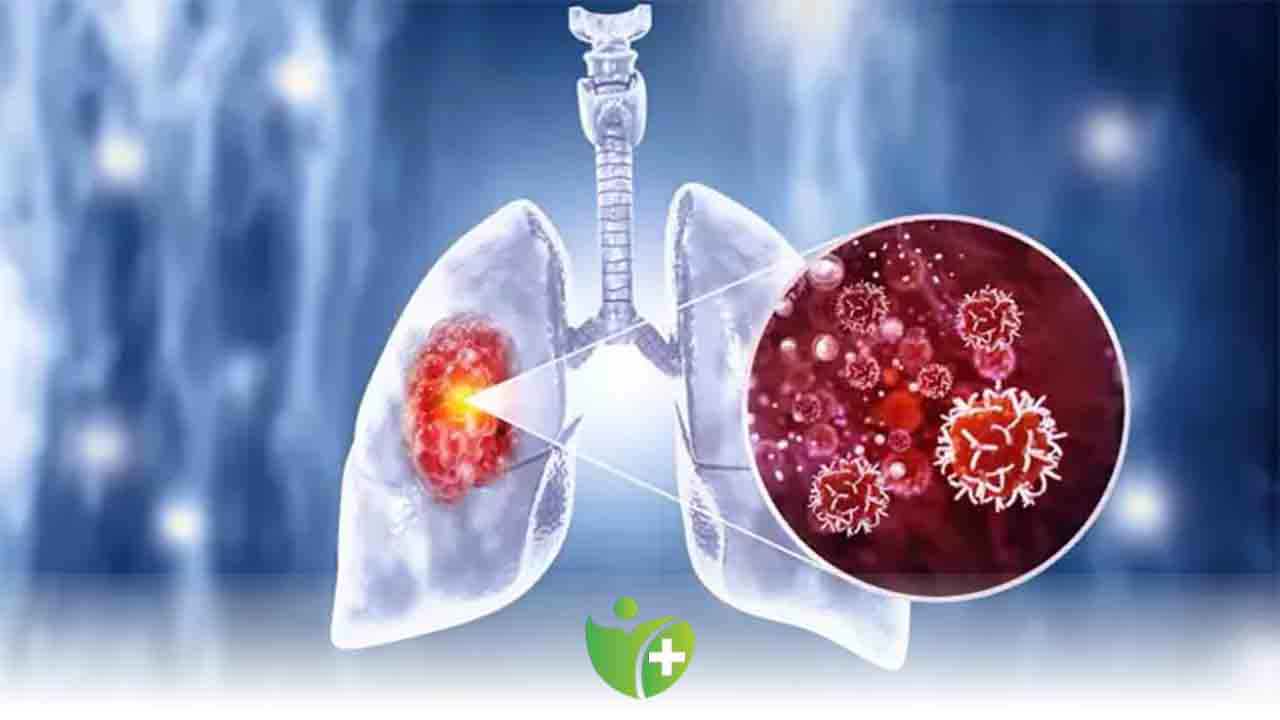 Akciğer kanserinin erken teşhisindeki gelişmeler umut veriyor 7