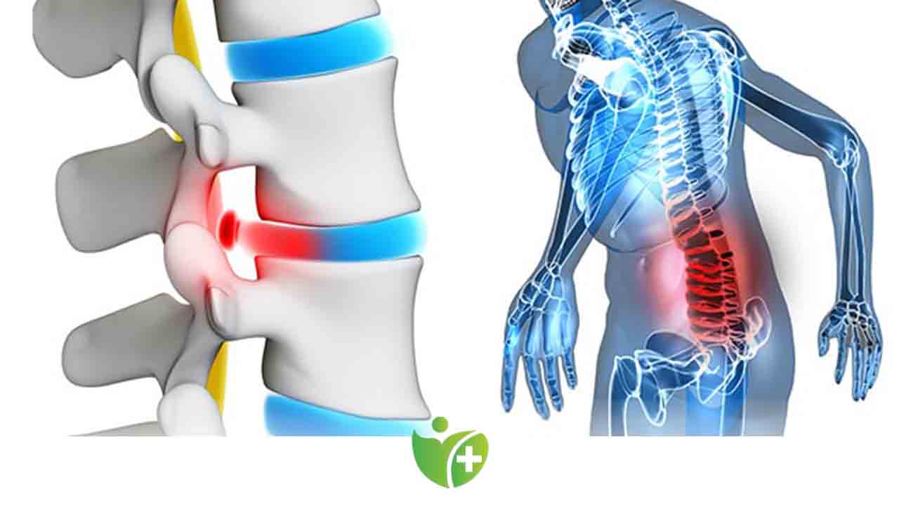 Yüzme, bel fıtığı oluşumunu engellemez! 7