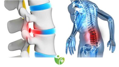 Bacağa vuran Bel Fıtığı ağrısı yaşıyorsanız 1