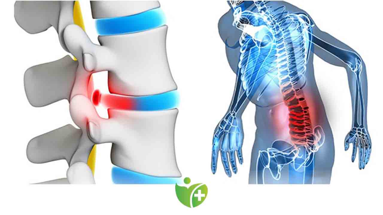 Bacağa vuran Bel Fıtığı ağrısı yaşıyorsanız 7