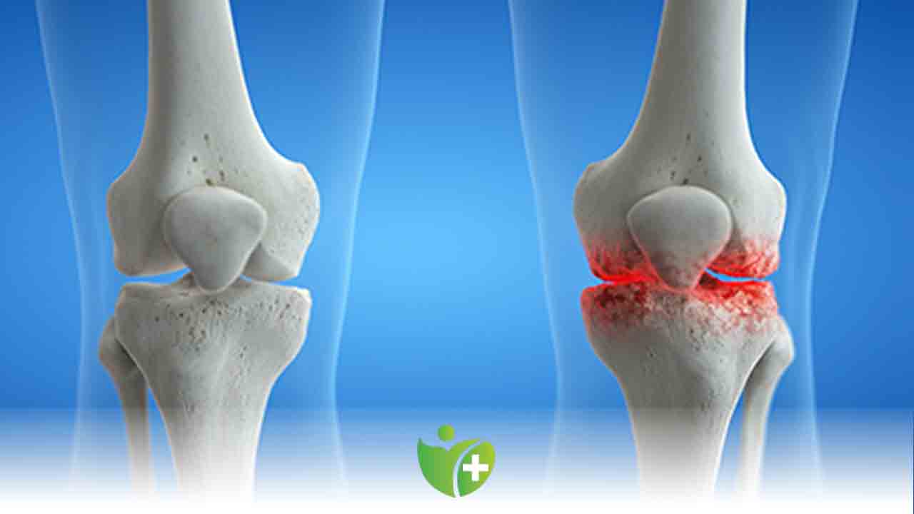 Diz Kireçlenmesi sorunu yaşıyorsanız 7