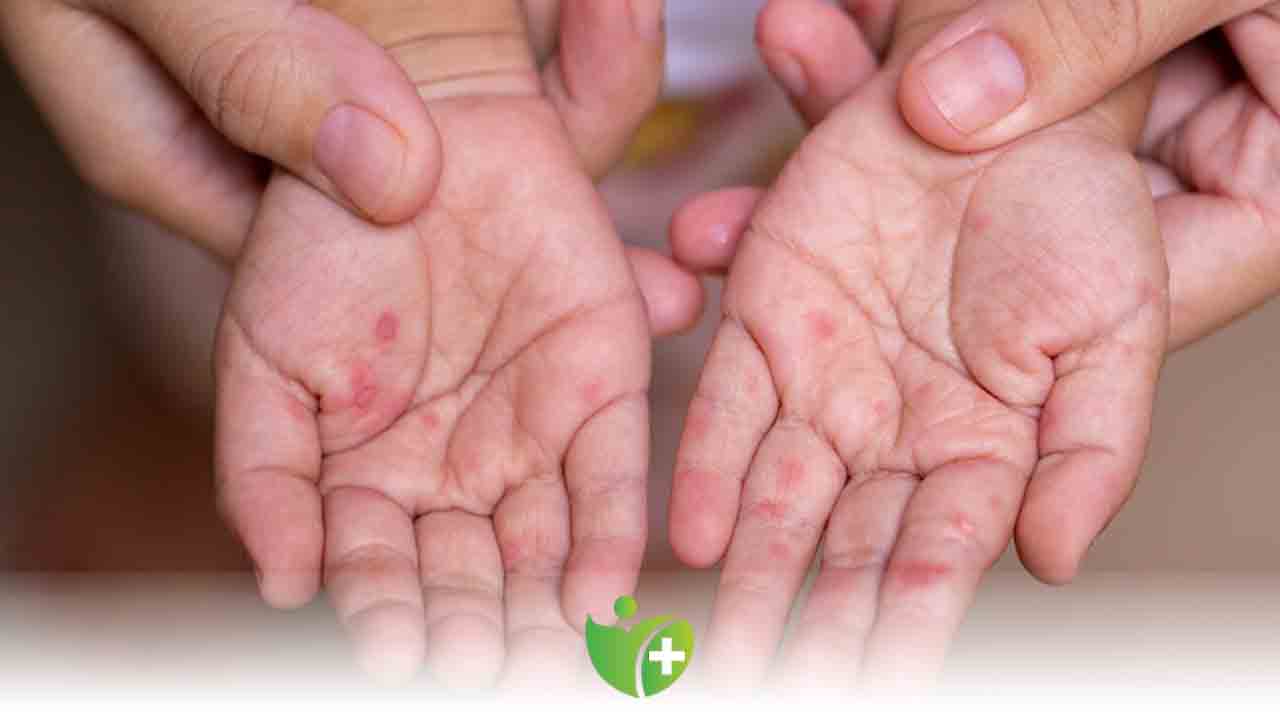 El Ayak Ağız hastalığı (Coxsackie) hakkında bilmeniz gerekenler 6