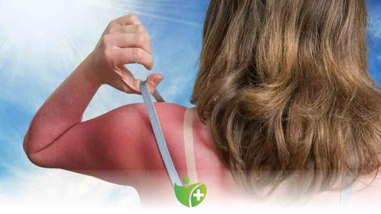 Güneşe Korunmasız çıkmayın 7