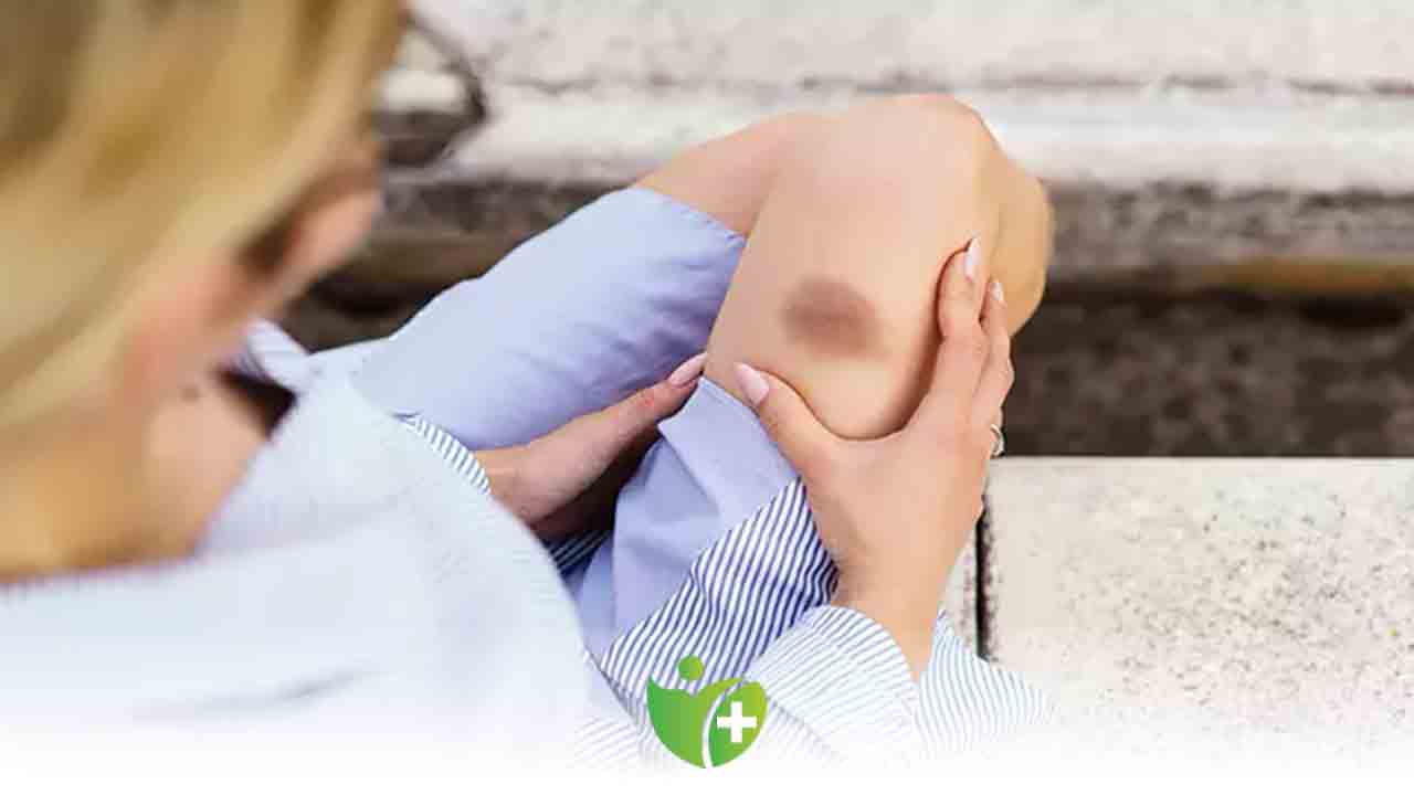 Kol ve bacaklarınız çabuk morarıyorsa dikkat! 7