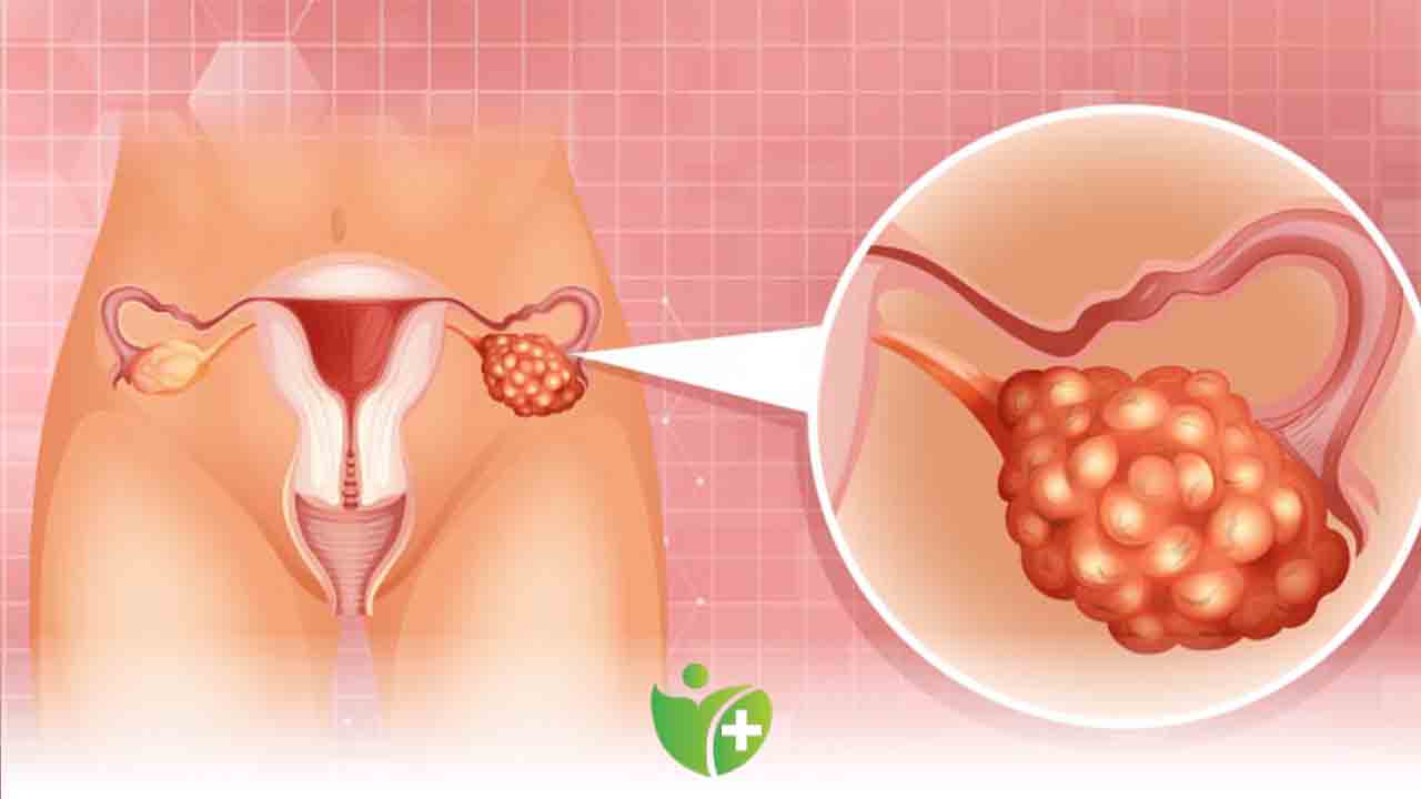 Fazla kiloların gizli nedeni bu Sendrom olabilir ! 7