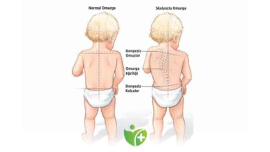 Çocuklarda iki Omuz arasında fark varsa Dikkat! 5