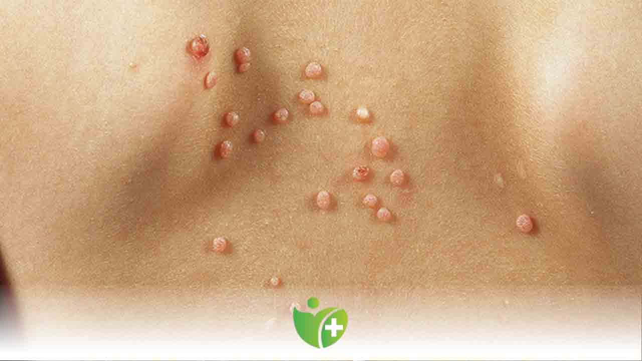 Çocuklarda ve Yetişkinlerde Molluscum Contagiosum Enfeksiyonuna karşı alınacak önlemler 7