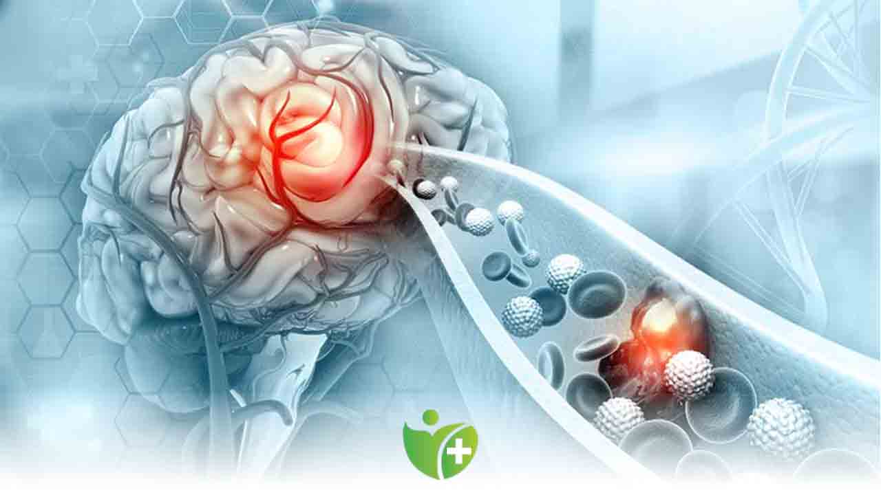 Yaz Sıcakları Beyin kanamasını tetikleyebiliyor 7