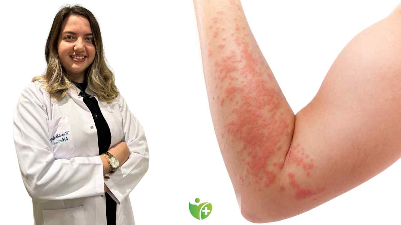 Yaz sonu Güneş alerjisine Dikkat 7