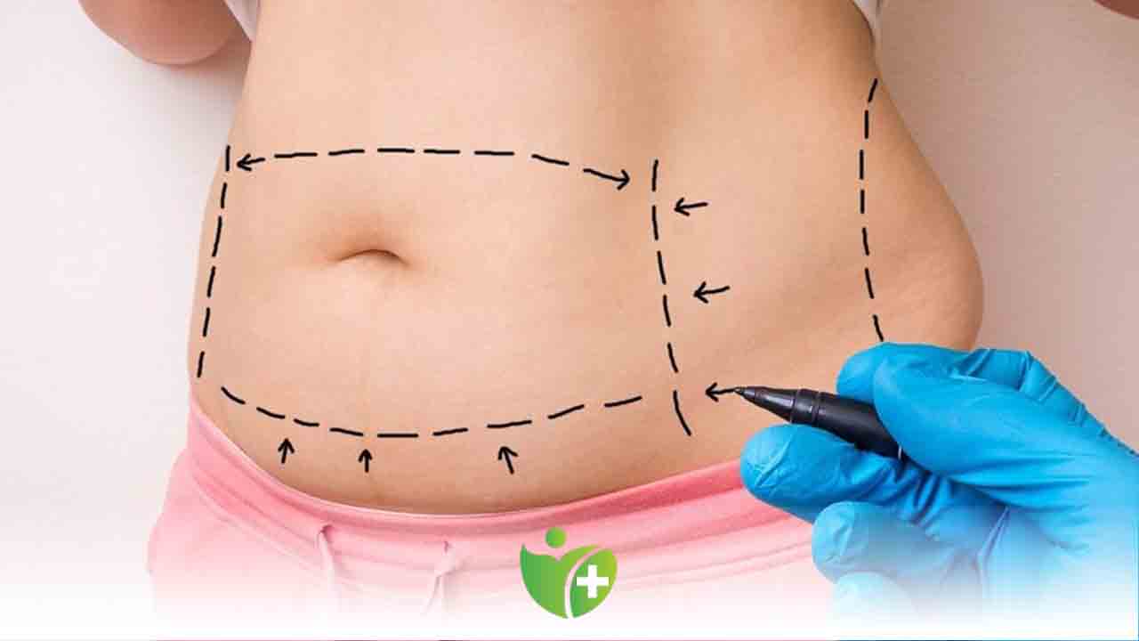 Karın Germe Operasyonu ile istediğiniz vücuda sahip olun 7