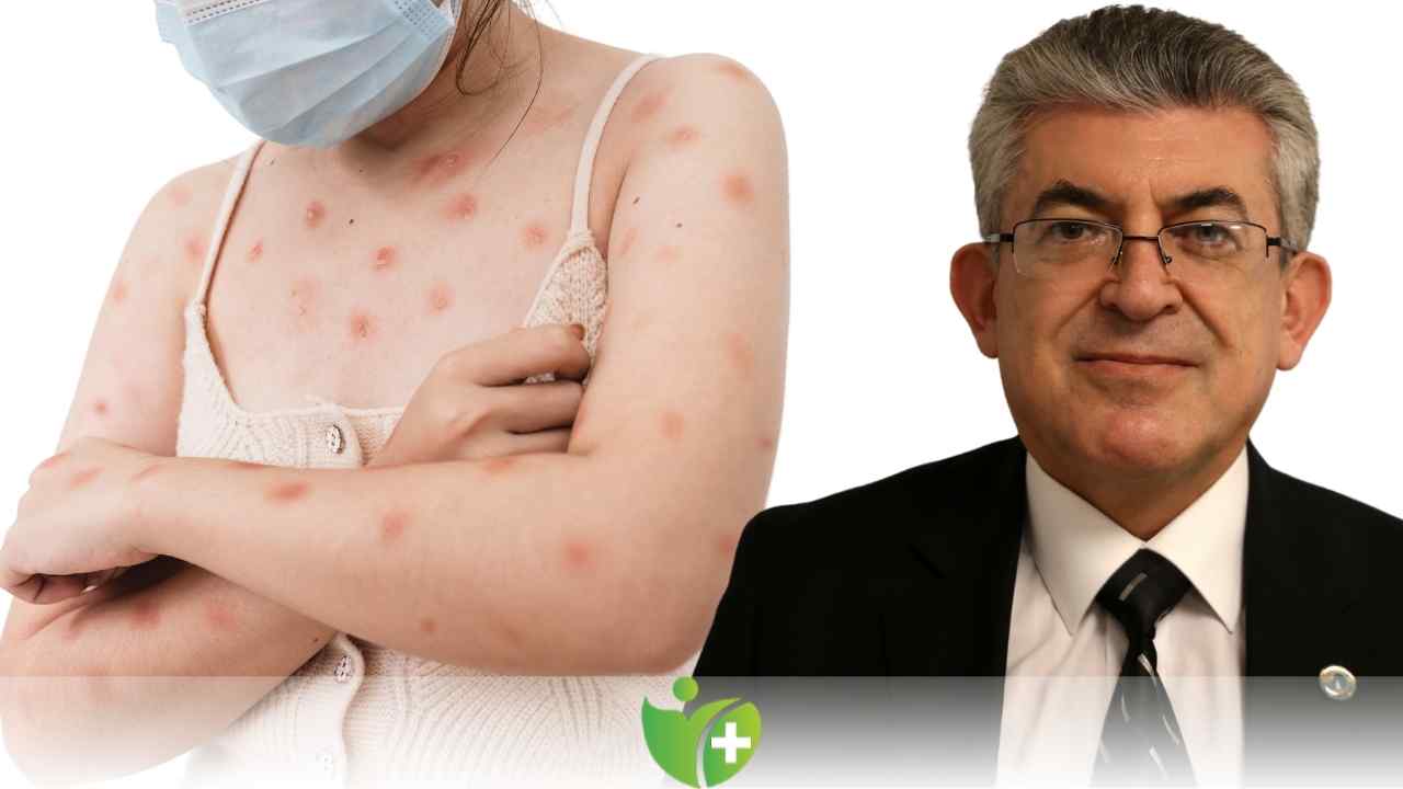 Mpox (Maymun Çiçeği) hastalığı hakkında bilinmesi gerekenler neler! 7