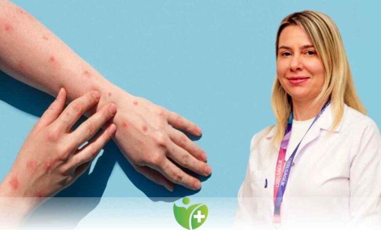 Maymun çiçeğinde Bağışıklık sistemi uyarısı 1