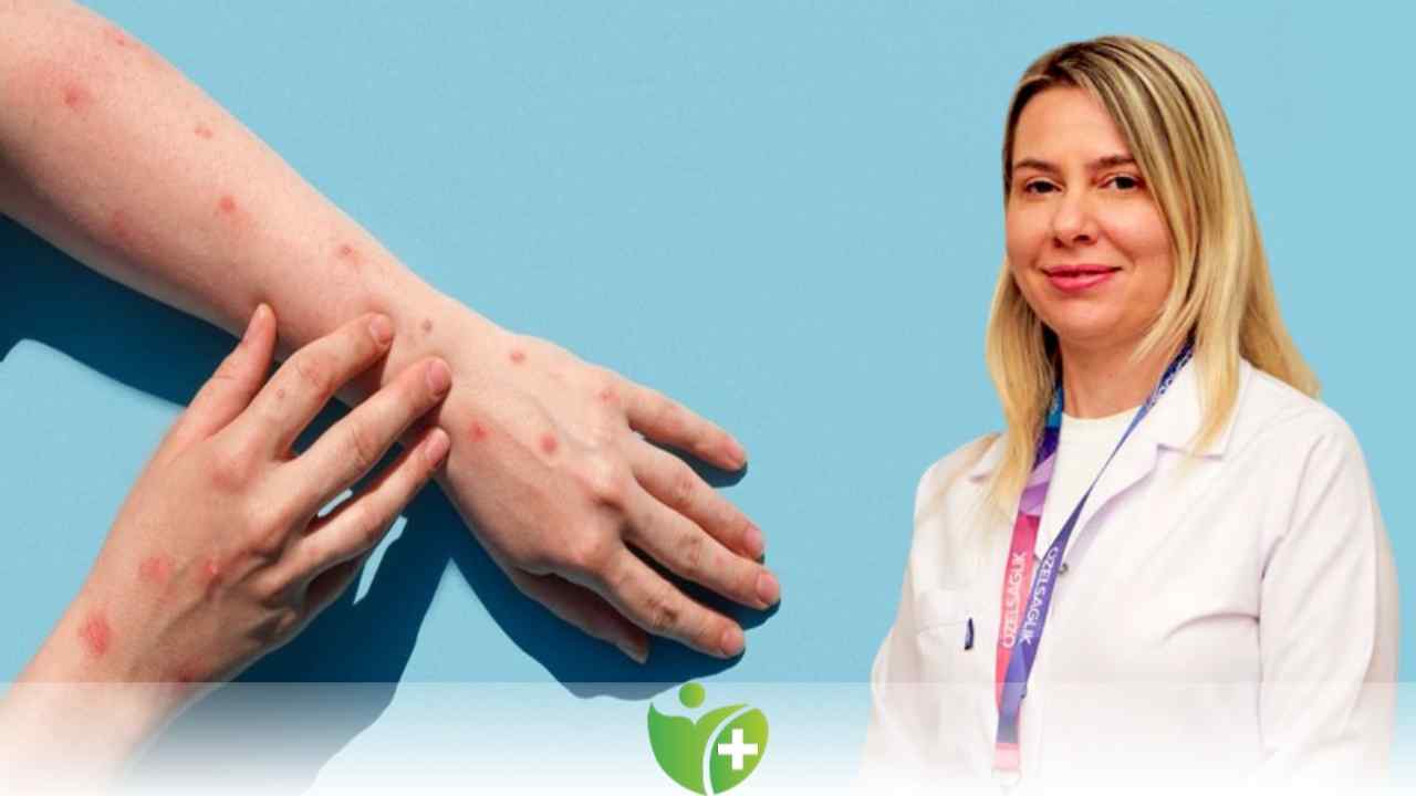 Maymun çiçeğinde Bağışıklık sistemi uyarısı 7