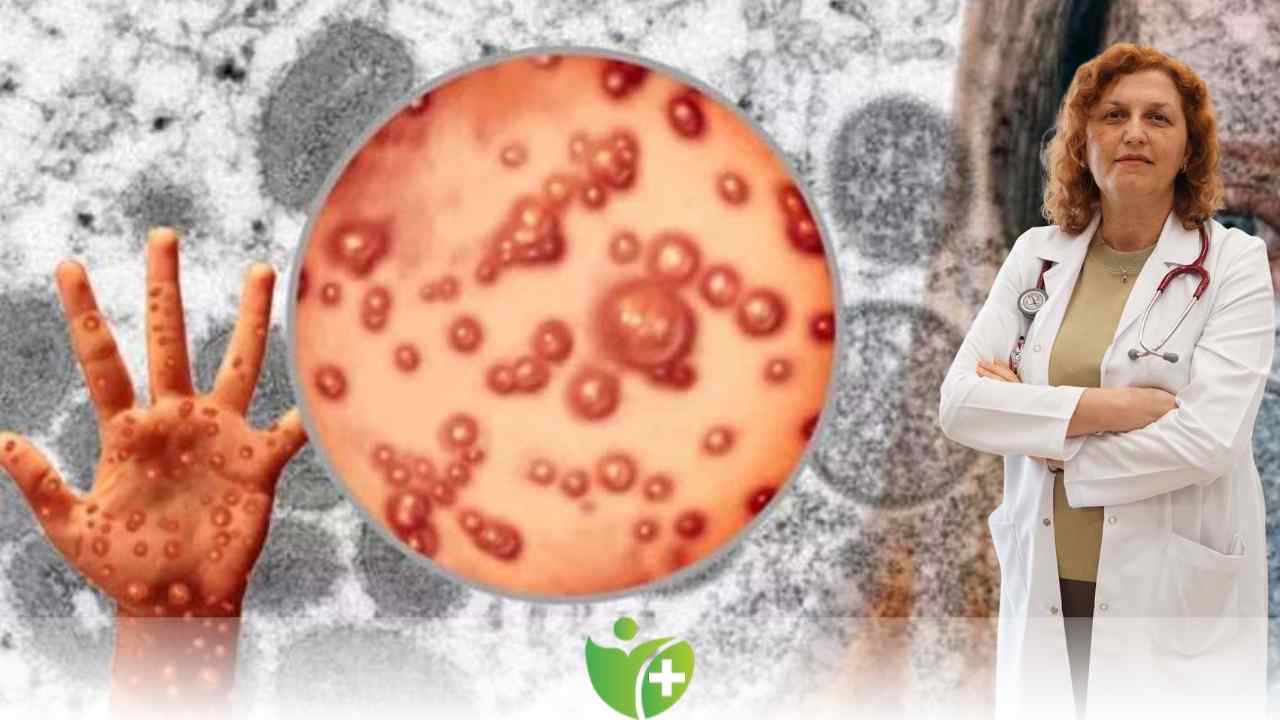 İşte maymun çiçeği virüsünün ilk belirtileri 7