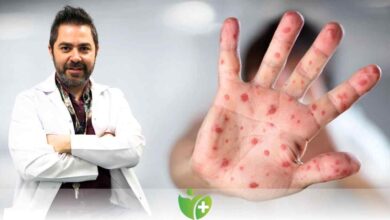 Maymun çiçeği virüsü Avrupa'ya sıçradı! 3