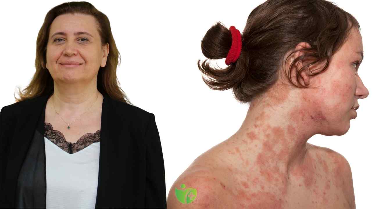 Atopik dermatit, doğru tanı ve uygun tedaviyle kontrol altına alınabilir. 7